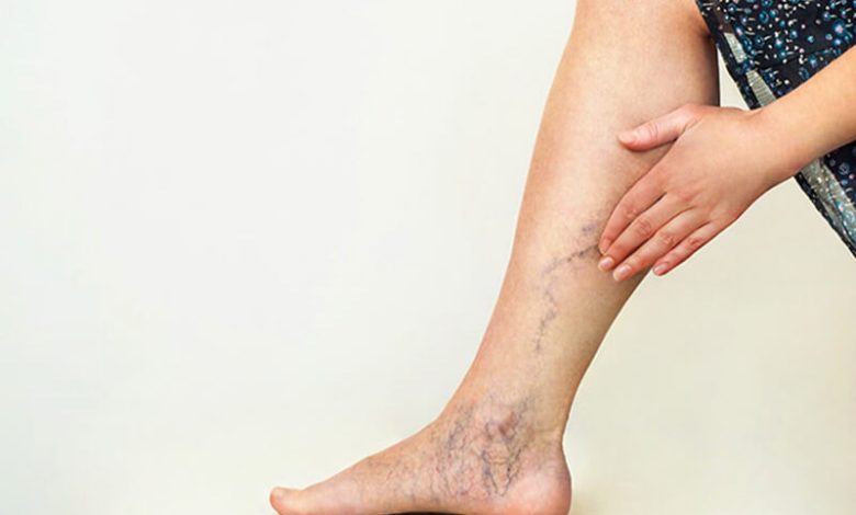 Giãn tĩnh mạch bàn chân có nguy hiểm không?