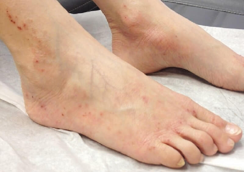 Giãn tĩnh mạch chân khiến da bị thay đổi màu - Hình ảnh suy giãn tĩnh mạch chân